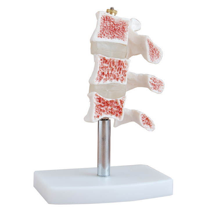 骨质疏松模型(脊椎典型病变模型).jpg