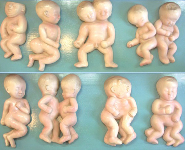 胎儿畸形模型.jpg