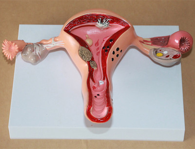 子宫卵巢病理病变模型.jpg